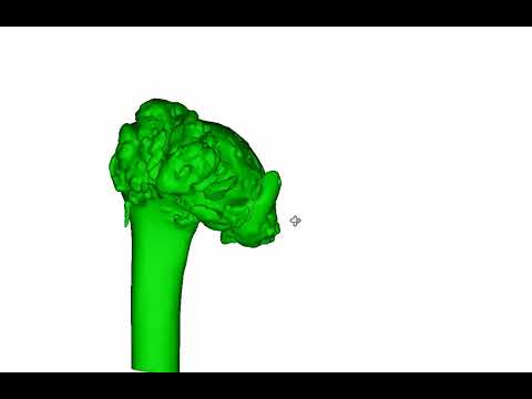 Coxa Magna , a typical case for custom medical implant and holographic navigation