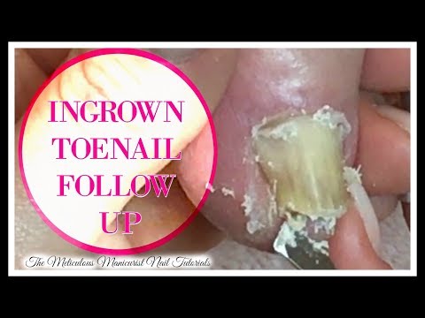 Paggamot ng kuko halamang-singaw hydrogen peroxide Uri ng kuko halamang-singaw