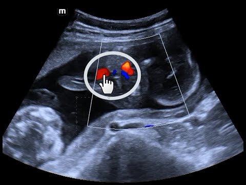 Tratamento com laser de sequência TRAP / feto acárdico - feto bomba