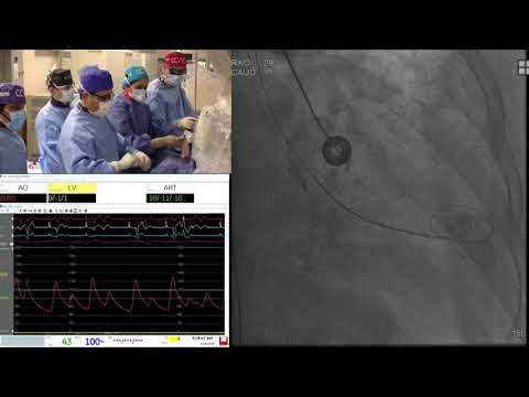 SAPIEN 3 TAVR - Live Case 1