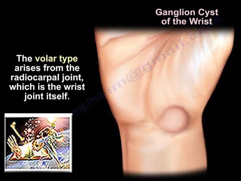 Ganglion Cyst  Wrist - Everything You Need To Know - Dr. Nabil Ebraheim