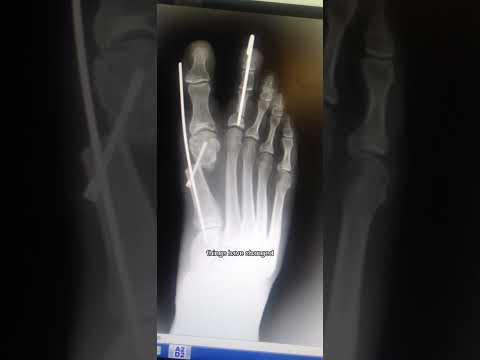 Foot Transformation After 10 Years! AMI® Bunion