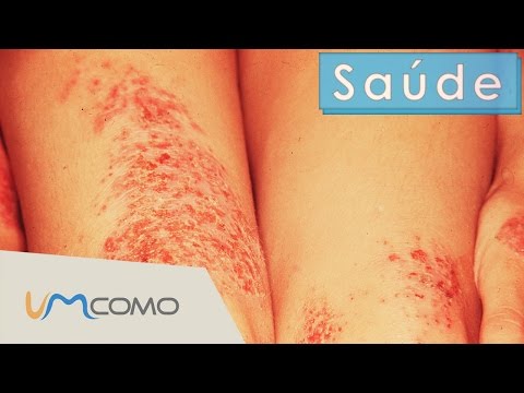 Tratamento de psoríase em respostas de sanatório Psoríase perto de uma orelha