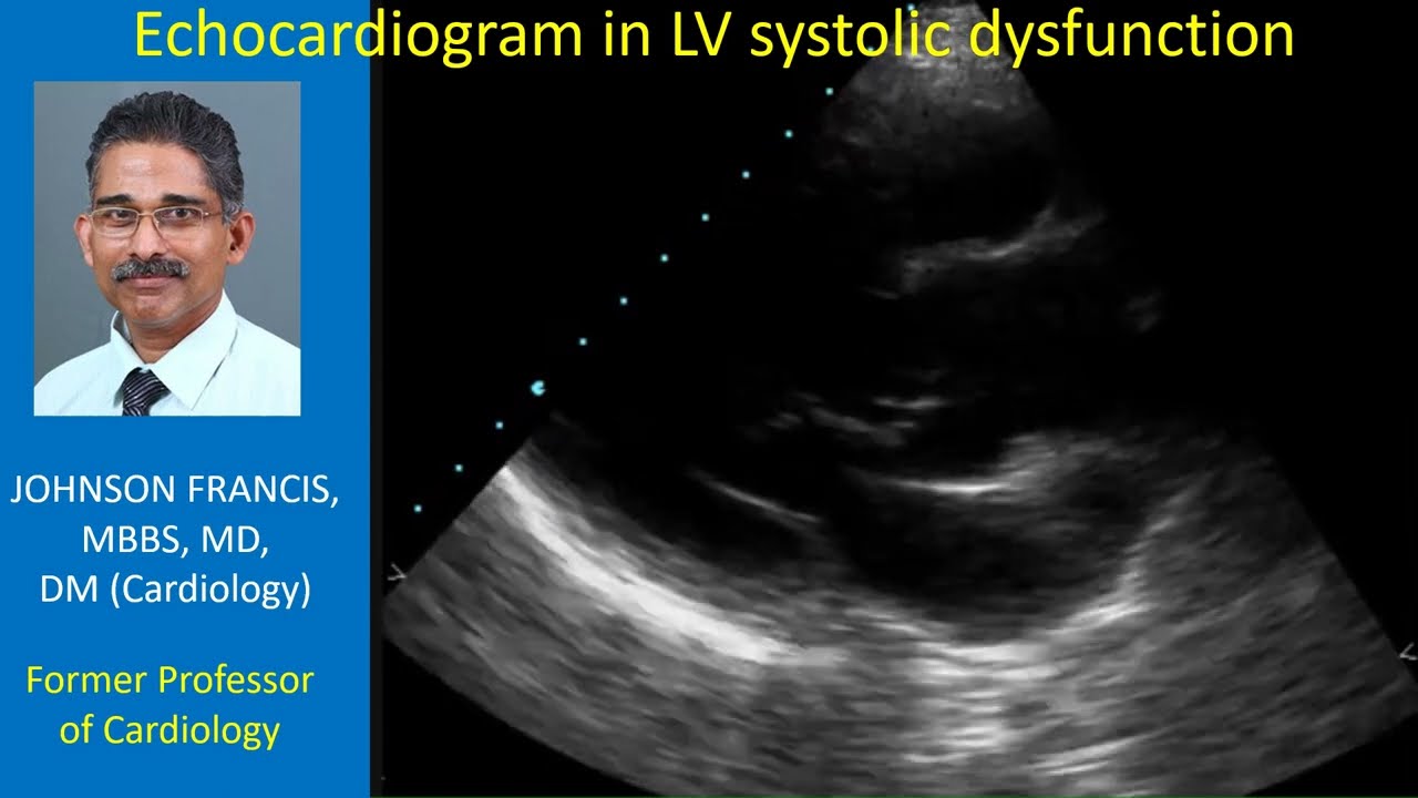 Echocardiogram in left ventricular systolic dysfunction