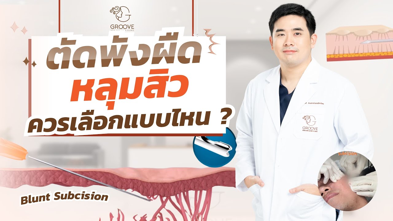 รีวิวรักษาหลุมสิว