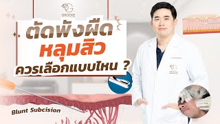 เทคนิค Subcision