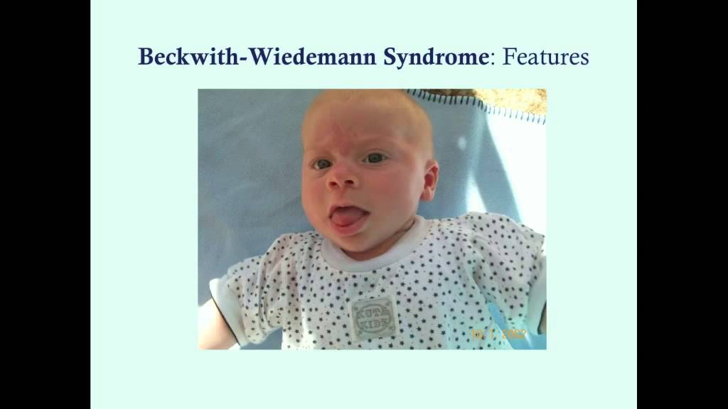 Beckwith-Wiedemann Syndrome - CRASH! Medical Review Series