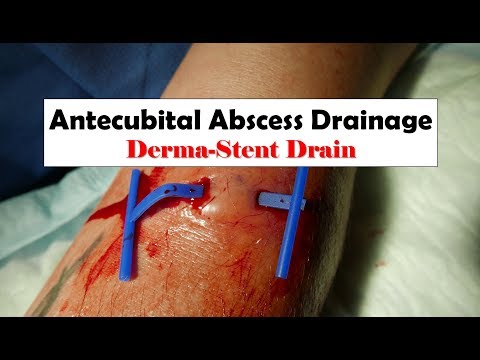 Abscess Drainage with a Derma-Stent Drain