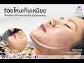 ร้อยไหม หน้าเรียว
