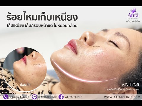ร้อยไหม หน้าเรียว