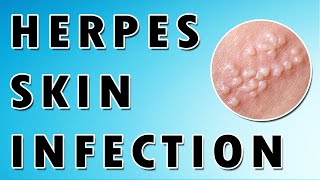 Herpes Simplex Virus Symptoms and Treatment