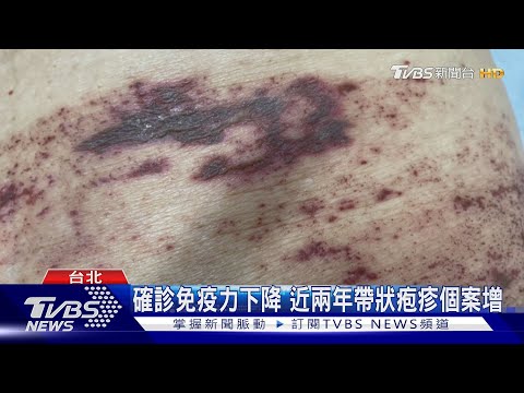 確診免疫力下降 近兩年帶狀疱疹個案增