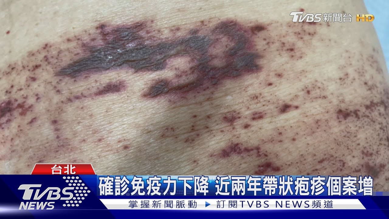 確診免疫力下降 近兩年帶狀疱疹個案增