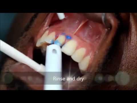 How to bond an e.max crown