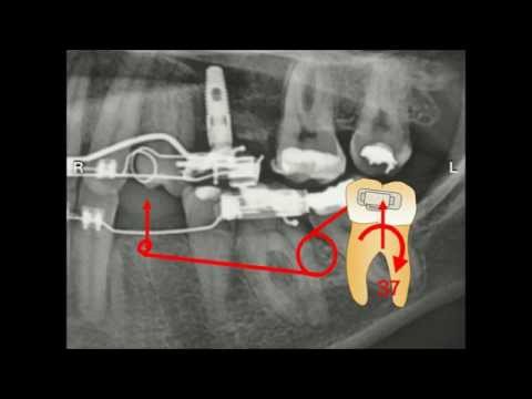 download lagu mp3 mp4 Lingual Orthodontics Course Korea, download lagu Lingual Orthodontics Course Korea gratis, unduh video klip Lingual Orthodontics Course Korea