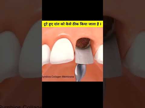टूटे हुए दांत को कैसे ठीक किया जाता है ?#brokenteeth​ #short​