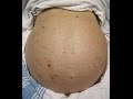 Spontaneous Bacterial Peritonitis SBP