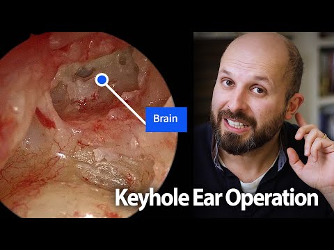 Watch a Mastoid Operation