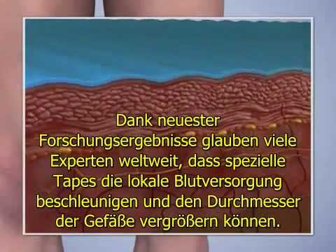 Die Präparate bei der Behandlung disgidrotitscheskoj das Ekzem Die Rezensionen über die ergebnisreiche Behandlung der Schuppenflechte
