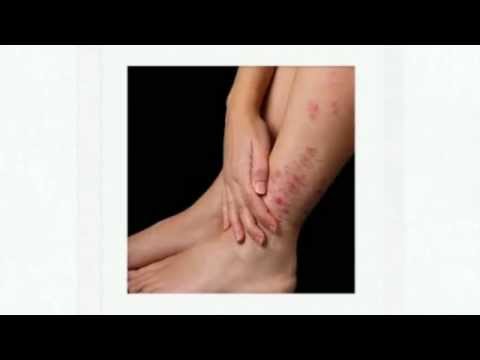 Trattamento chistotely monetovidny eczema Cura di eczema a rimedi di gente per bambini