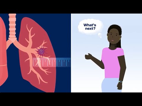 What Happens After Your Doctor Finds a Lung Nodule (Pulmonary Nodule)?