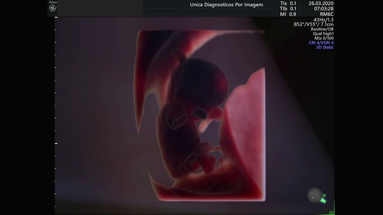 Ultrassom 4D em feto de 11 semanas