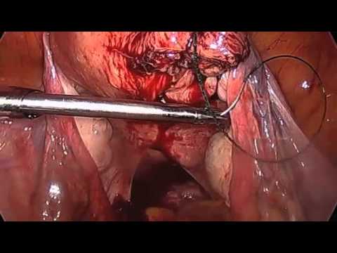 Laparoskopische Myomektomie und Burch-Operation
