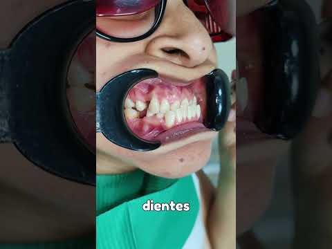Video del tratamiento de mordida invertida en adulto