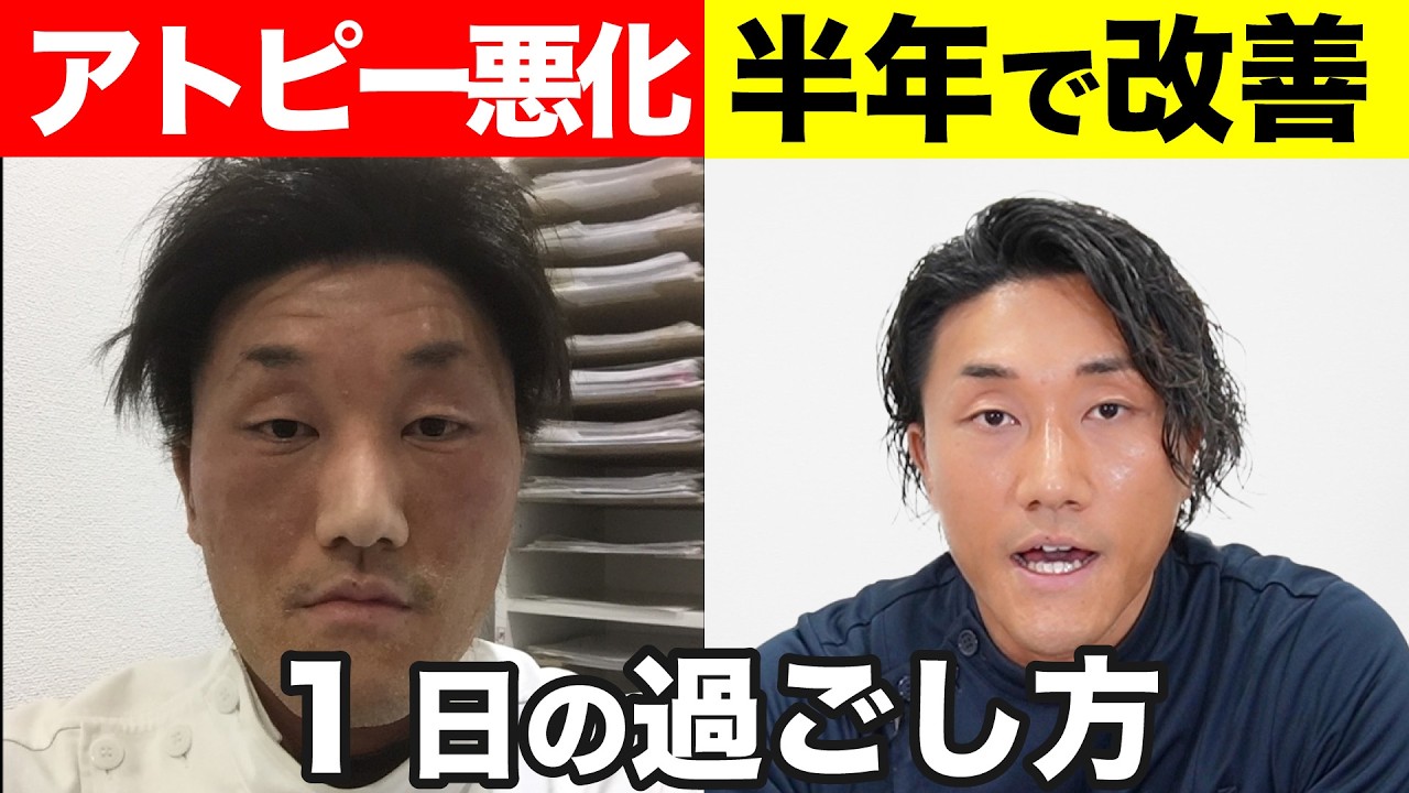 【実体験】アトピー地獄から半年で改善した「1日のルーティン」全部話します