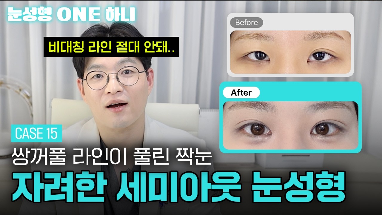 라인이 풀려버린 짝눈 고민이라면?🤔 | 눈성형 ONE 하니 쇼츠 영상 미리보기