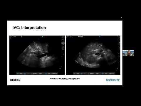 Webinar: An Introduction to VExUS