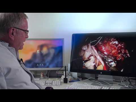 Prostatitis, Gewicht zu verlieren Aggressiver Prostata-Krebs