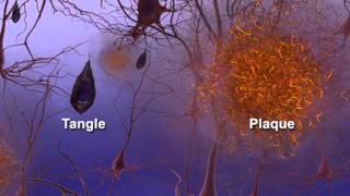 Inside the Brain: Unraveling the Mystery of Alzheimer's Disease