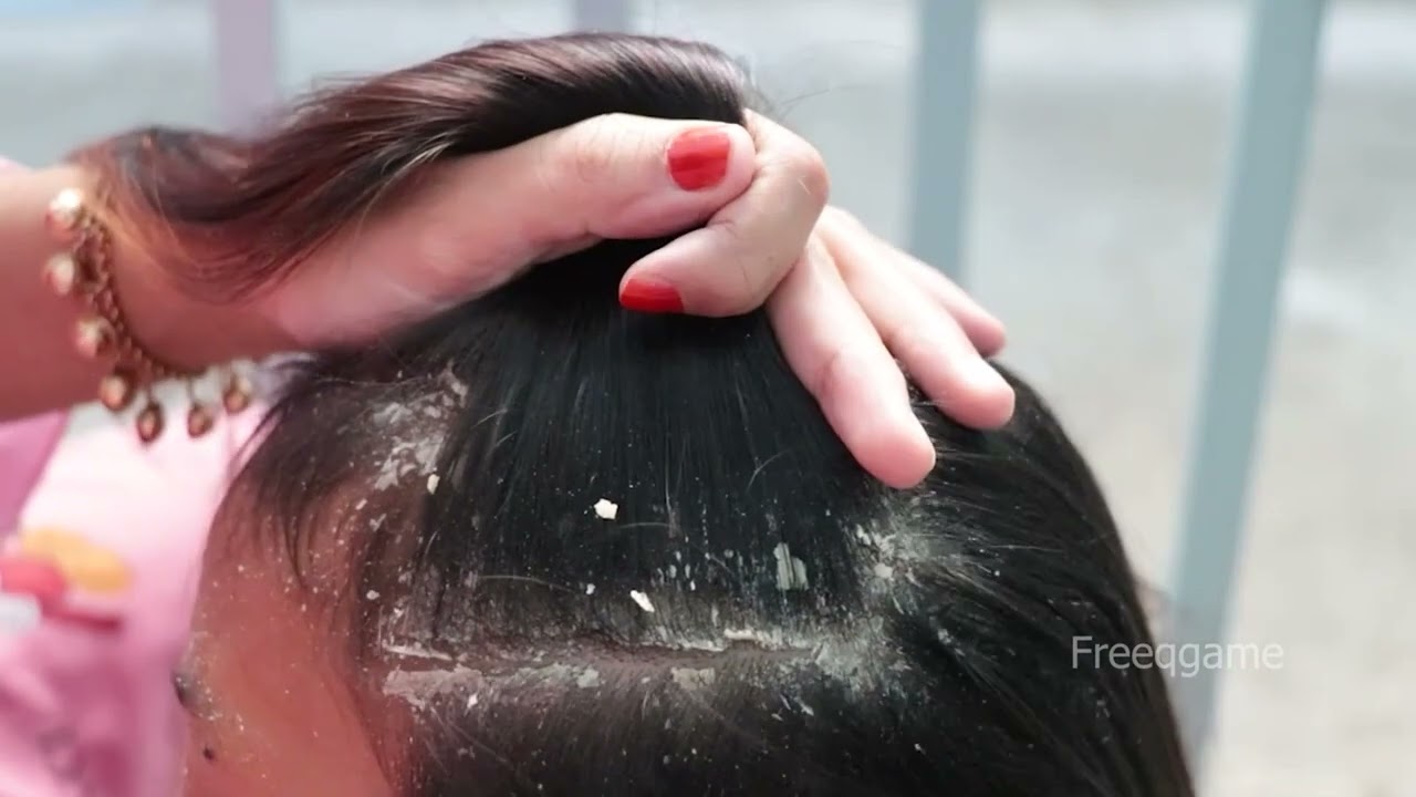 Satisfy Dandruff Removal.