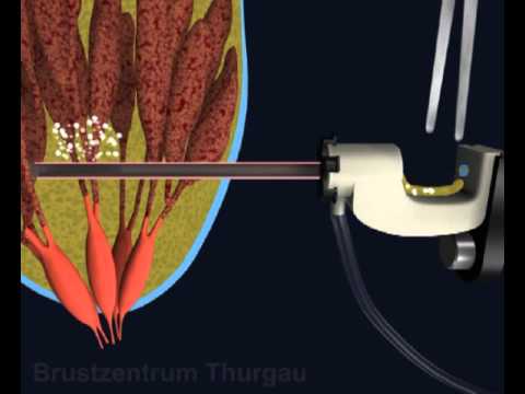 Was mit bakterieller Prostatitis zu tun Prostata und Prostata-Erkrankungen