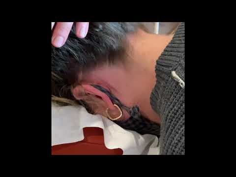 landmarking: Occiput, GB 12, AnMian, BL10, GB20