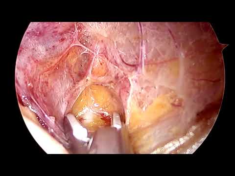 Surgical Window Ovarian Vessel Ligation