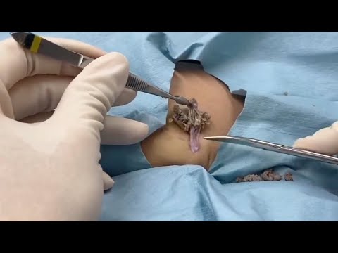 Stubborn cyst didn’t want to burst