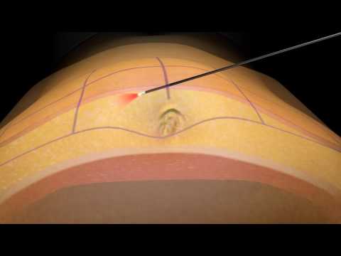 One SmartLipo Treatment on One Small Area of Choice at Vedas Medical Spa and Wellness Center (Up to 67% off) - Second Medium