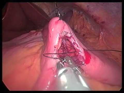 SILS Gastric Bypass