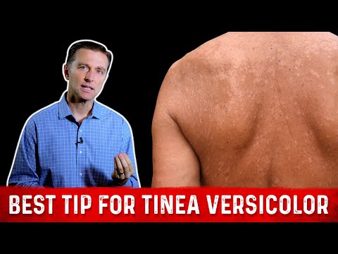 Natural (Skin Fungus) Tinea Versicolor Home Remedies – Dr. Berg