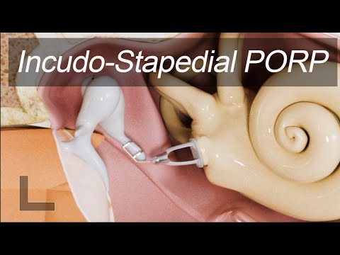 Middle Ear Joint Replacement - Partial Ossicular Replacement Prosthesis (IS-PORP)