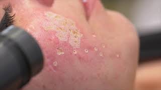 El Dr. Didac Barco enseña cómo tratar cicatrices de acné con láser CO2