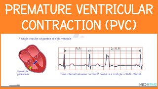 Premature Ventricular Contractions (PVCs) Explained