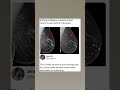 AI Is Useful Ai Breastcancer Makemeviral Memes Blowthisaccountup Viralshort Memepage