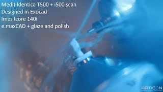 Imes Icore 140i - e.maxCAD + glaze and polish (medit T500+i500 scan, designed in Exocad)