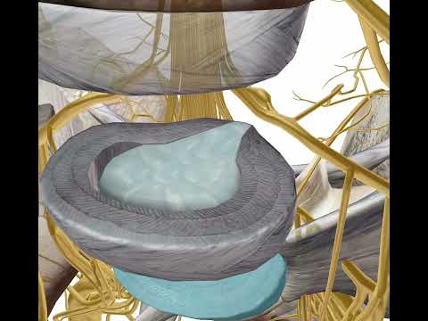 CUÁL ES LA DIFERENCIA ENTRE PROTRUSIÓN DISCAL Y HERNIA DISCAL?