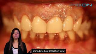 Non-ablative Depigmentation Of Gingiva using 450nm wavelength of S1 Pioon Laser