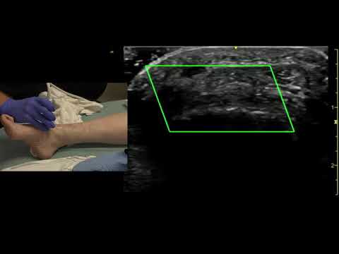Ultrasound of the Dorsalis Pedis Artery