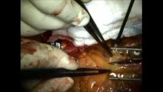 J. Mark Morales, M.D. Off Pump Coronary Artery Bypass Graft